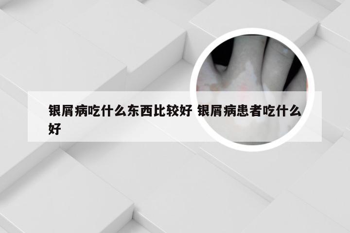 银屑病吃什么东西比较好 银屑病患者吃什么好
