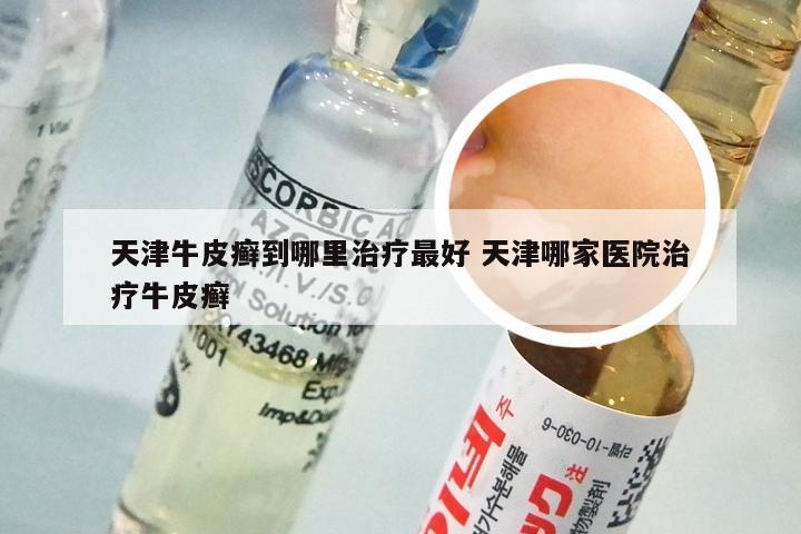 天津牛皮癣到哪里治疗最好 天津哪家医院治疗牛皮癣