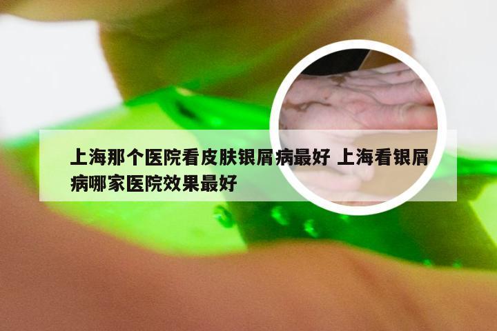 上海那个医院看皮肤银屑病最好 上海看银屑病哪家医院效果最好