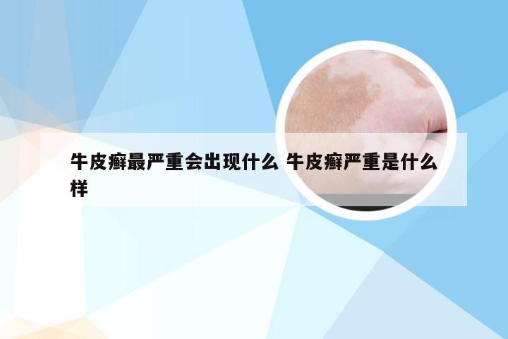 牛皮癣最严重会出现什么 牛皮癣严重是什么样