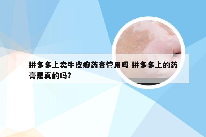 拼多多上卖牛皮癣药膏管用吗 拼多多上的药膏是真的吗?