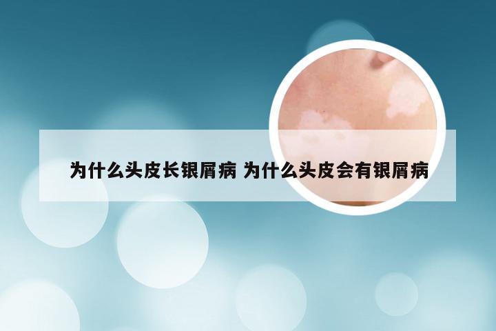 为什么头皮长银屑病 为什么头皮会有银屑病
