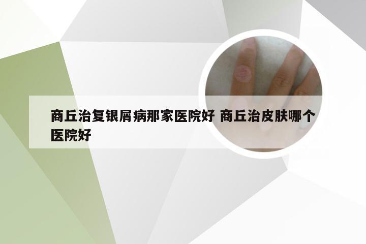 商丘治复银屑病那家医院好 商丘治皮肤哪个医院好