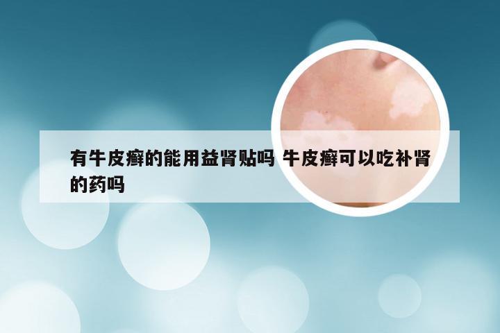 有牛皮癣的能用益肾贴吗 牛皮癣可以吃补肾的药吗