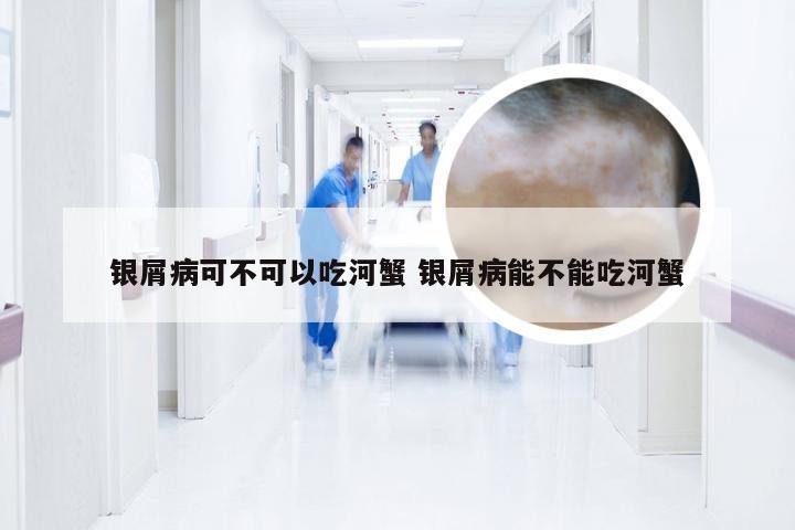 银屑病可不可以吃河蟹 银屑病能不能吃河蟹
