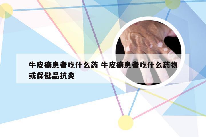 牛皮癣患者吃什么药 牛皮癣患者吃什么药物或保健品抗炎