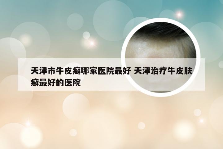 天津市牛皮癣哪家医院最好 天津治疗牛皮肤癣最好的医院