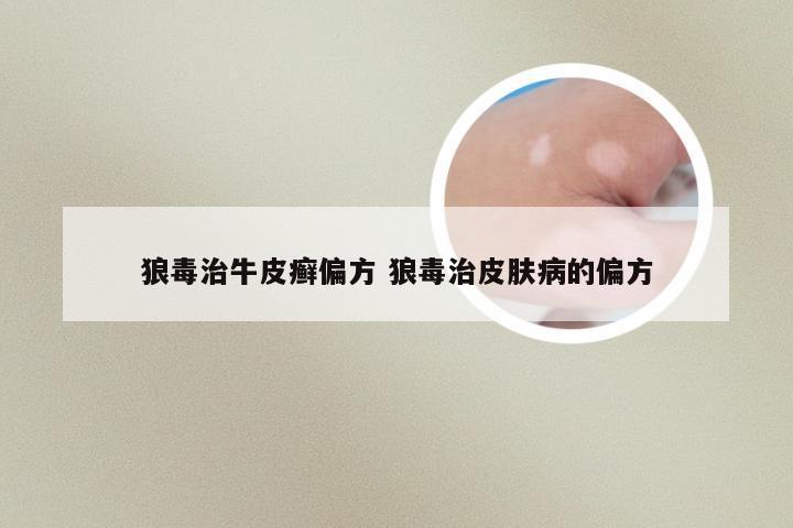 狼毒治牛皮癣偏方 狼毒治皮肤病的偏方