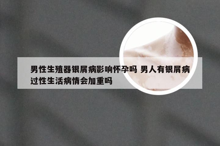 男性生殖器银屑病影响怀孕吗 男人有银屑病过性生活病情会加重吗