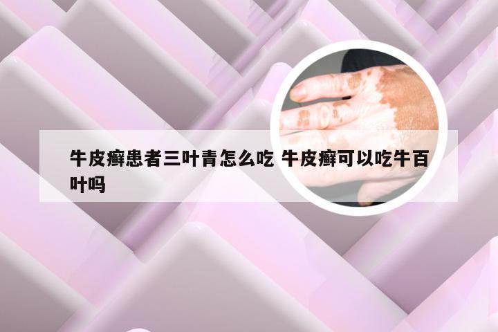 牛皮癣患者三叶青怎么吃 牛皮癣可以吃牛百叶吗