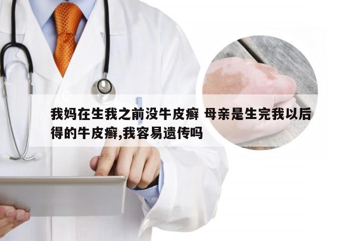 我妈在生我之前没牛皮癣 母亲是生完我以后得的牛皮癣,我容易遗传吗