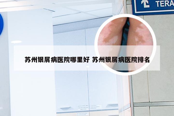 苏州银屑病医院哪里好 苏州银屑病医院排名