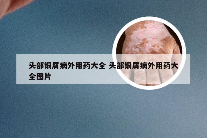 头部银屑病外用药大全 头部银屑病外用药大全图片