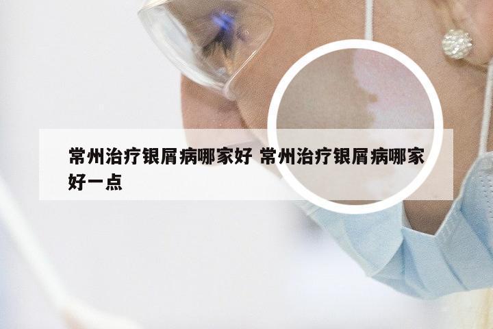 常州治疗银屑病哪家好 常州治疗银屑病哪家好一点