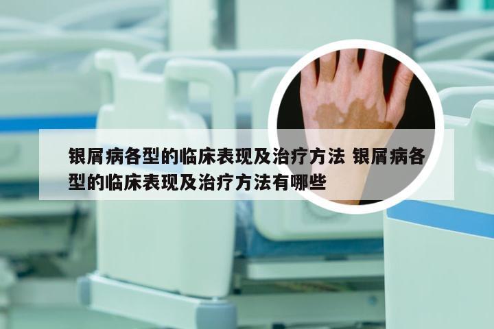 银屑病各型的临床表现及治疗方法 银屑病各型的临床表现及治疗方法有哪些