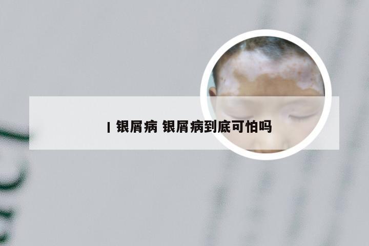 丨银屑病 银屑病到底可怕吗