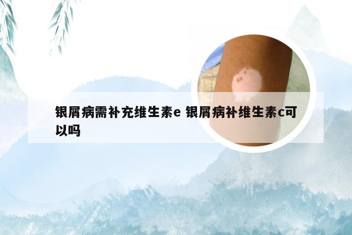 银屑病需补充维生素e 银屑病补维生素c可以吗