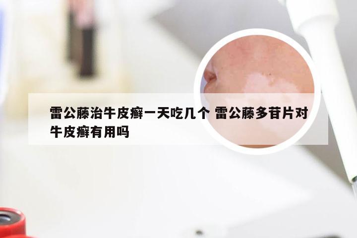 雷公藤治牛皮癣一天吃几个 雷公藤多苷片对牛皮癣有用吗