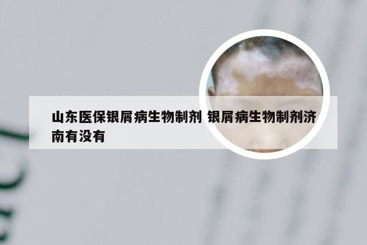 山东医保银屑病生物制剂 银屑病生物制剂济南有没有