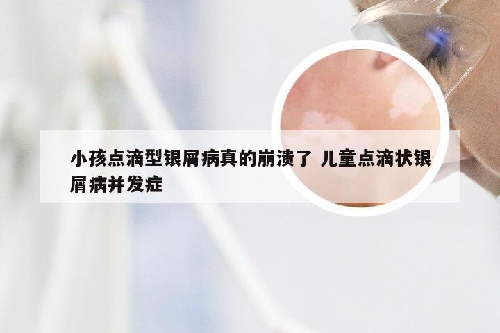 小孩点滴型银屑病真的崩溃了 儿童点滴状银屑病并发症