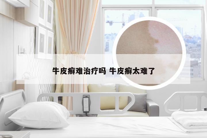 牛皮癣难治疗吗 牛皮癣太难了