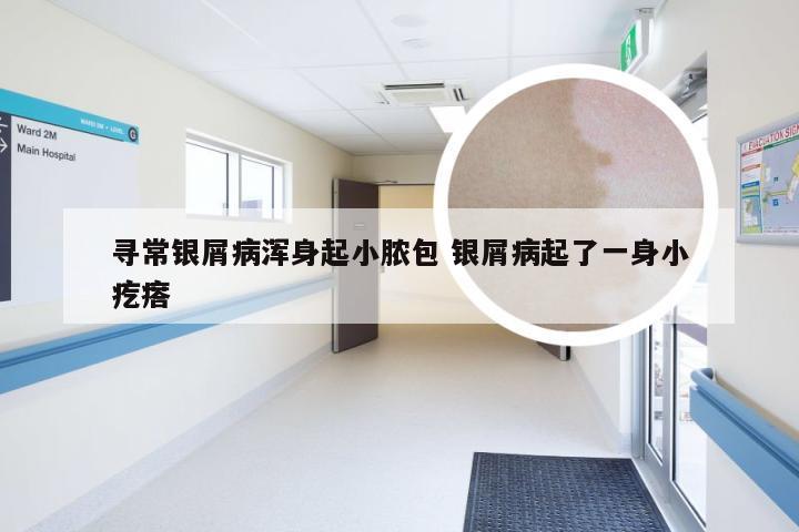 寻常银屑病浑身起小脓包 银屑病起了一身小疙瘩