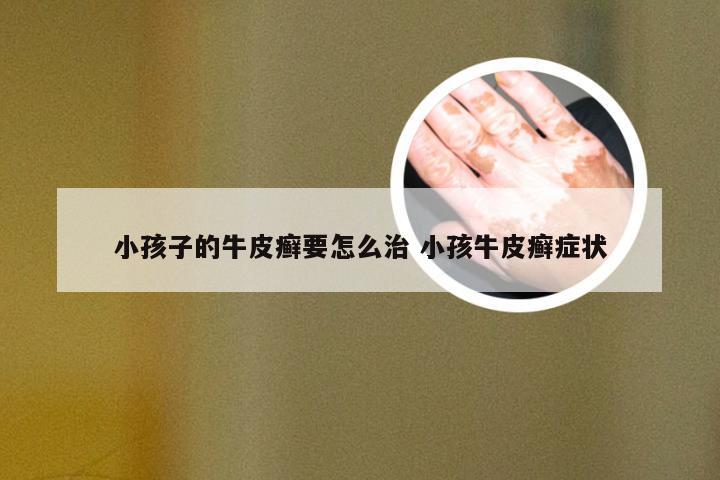 小孩子的牛皮癣要怎么治 小孩牛皮癣症状