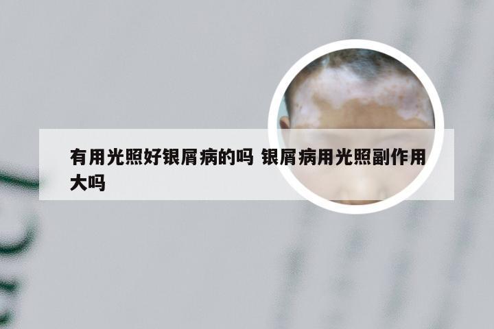 有用光照好银屑病的吗 银屑病用光照副作用大吗