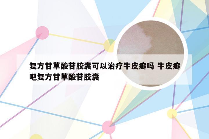 复方甘草酸苷胶囊可以治疗牛皮癣吗 牛皮癣吧复方甘草酸苷胶囊