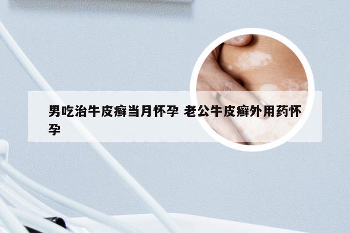 男吃治牛皮癣当月怀孕 老公牛皮癣外用药怀孕