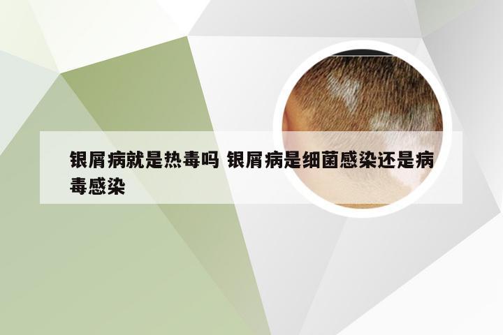 银屑病就是热毒吗 银屑病是细菌感染还是病毒感染