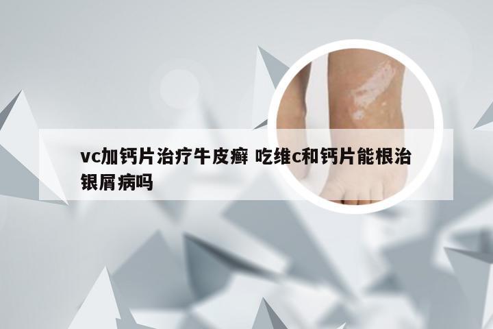 vc加钙片治疗牛皮癣 吃维c和钙片能根治银屑病吗