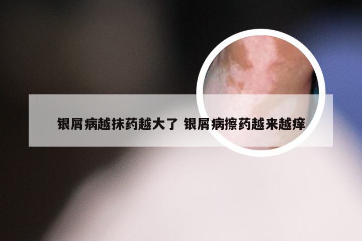 银屑病越抹药越大了 银屑病擦药越来越痒