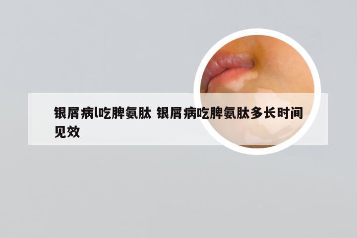 银屑病l吃脾氨肽 银屑病吃脾氨肽多长时间见效