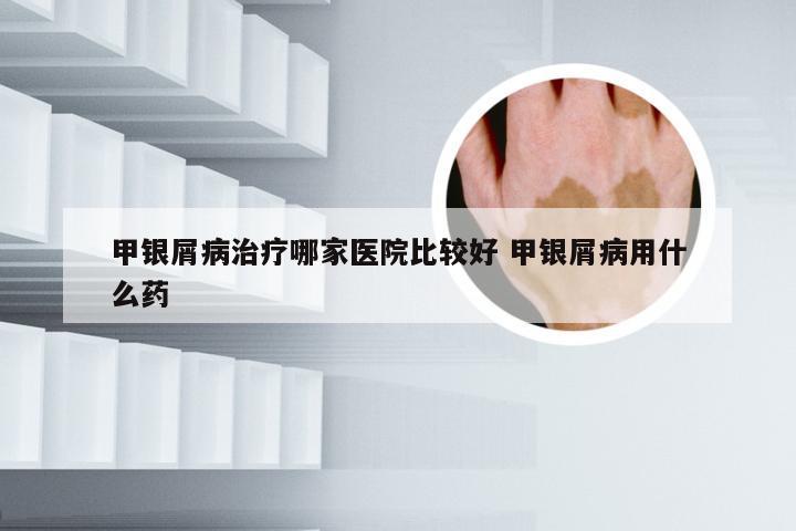 甲银屑病治疗哪家医院比较好 甲银屑病用什么药