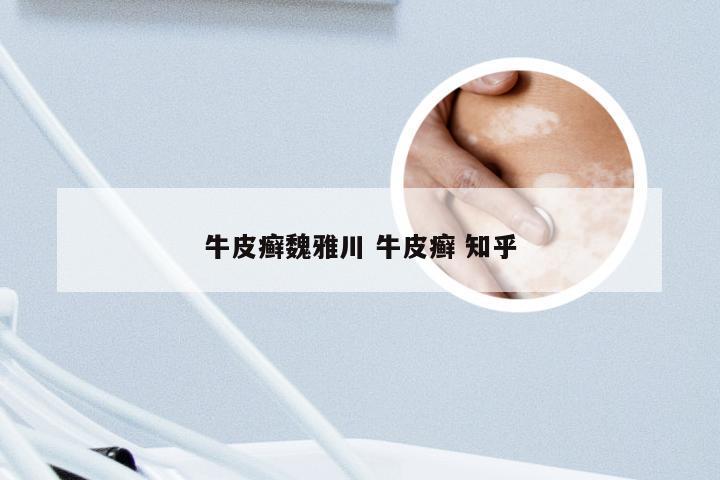 牛皮癣魏雅川 牛皮癣 知乎