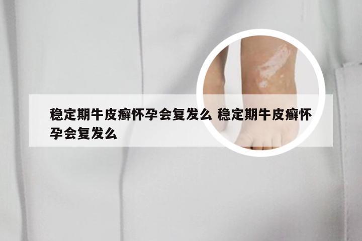 稳定期牛皮癣怀孕会复发么 稳定期牛皮癣怀孕会复发么