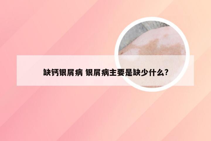 缺钙银屑病 银屑病主要是缺少什么?