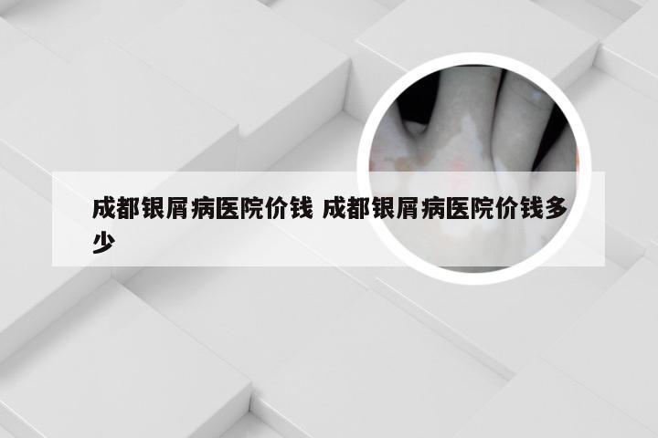 成都银屑病医院价钱 成都银屑病医院价钱多少