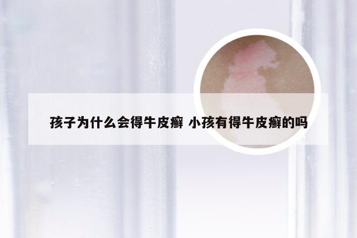 孩子为什么会得牛皮癣 小孩有得牛皮癣的吗