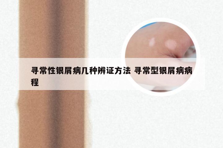 寻常性银屑病几种辨证方法 寻常型银屑病病程