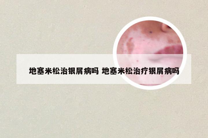 地塞米松治银屑病吗 地塞米松治疗银屑病吗