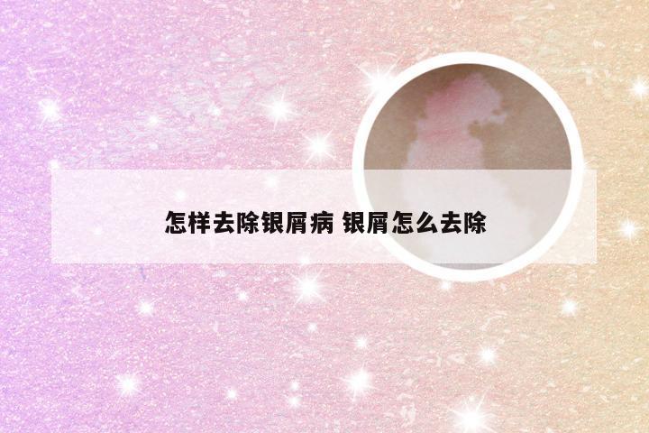 怎样去除银屑病 银屑怎么去除