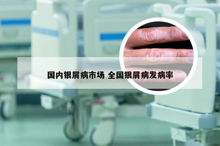 国内银屑病市场 全国银屑病发病率