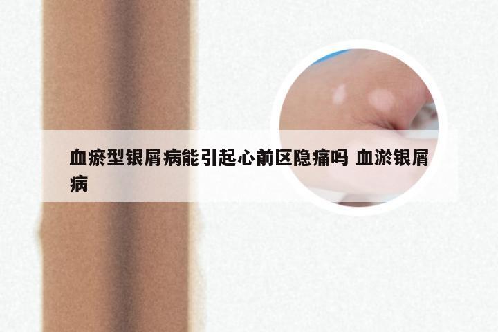 血瘀型银屑病能引起心前区隐痛吗 血淤银屑病