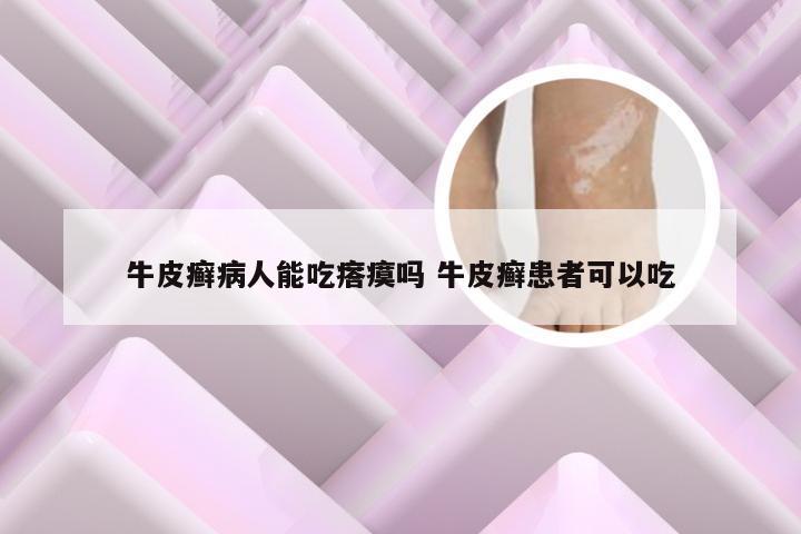 牛皮癣病人能吃瘩瘼吗 牛皮癣患者可以吃