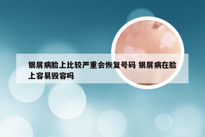 银屑病脸上比较严重会恢复号码 银屑病在脸上容易毁容吗