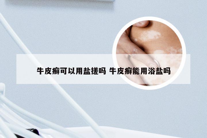 牛皮癣可以用盐搓吗 牛皮癣能用浴盐吗
