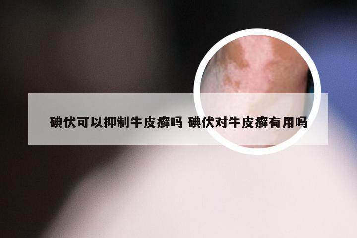 碘伏可以抑制牛皮癣吗 碘伏对牛皮癣有用吗