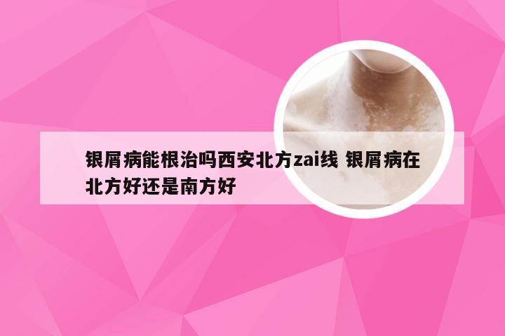 银屑病能根治吗西安北方zai线 银屑病在北方好还是南方好